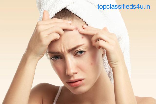 Effective Acne Treatment in Greater Kailash at Soul Derma Clinic