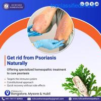 Psoriatic Arthritis Treatment | Psoriatic Scalp Treatment
