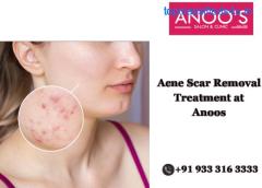 Clear Skin Confidence: Anoos Acne Removal Treatment