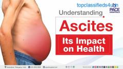 Ascites - Symptoms, Causes, Complications, Prevention and Treatment