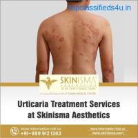 Chronic Urticaria Treatment