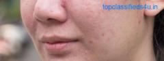 Magna Centre for Specialist Doctors' Effective Acne Treatment in Hyderabad
