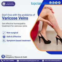 Varicose Veins Homeopathy Treatments in Bangalore -Rich Care 