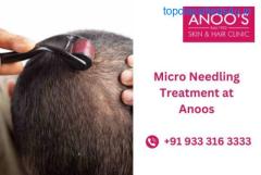 Advanced Microneedling treatment for hair loss at ANOOS